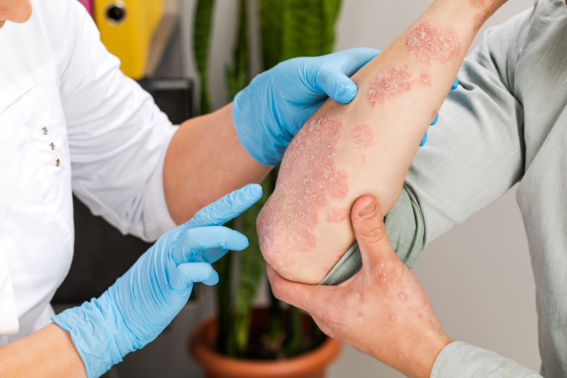 Profesní alergická kontaktní dermatitida