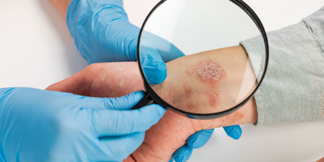Profesní kontaktní alergická dermatitida jako nemoc z povolání