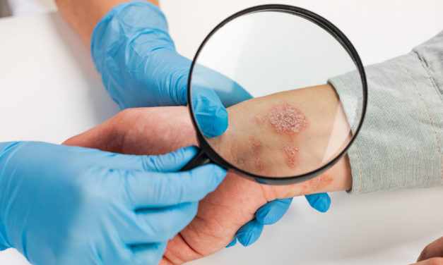 Profesní kontaktní alergická dermatitida jako nemoc z povolání