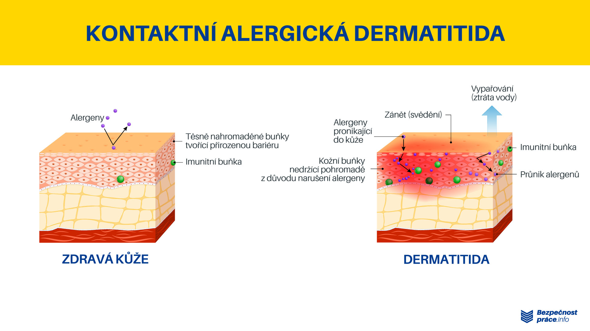 Jak vzniká kontaktní alergická dermatitida?